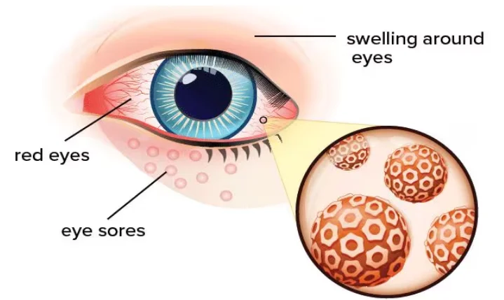Herpes Zoster Ophthalmicus