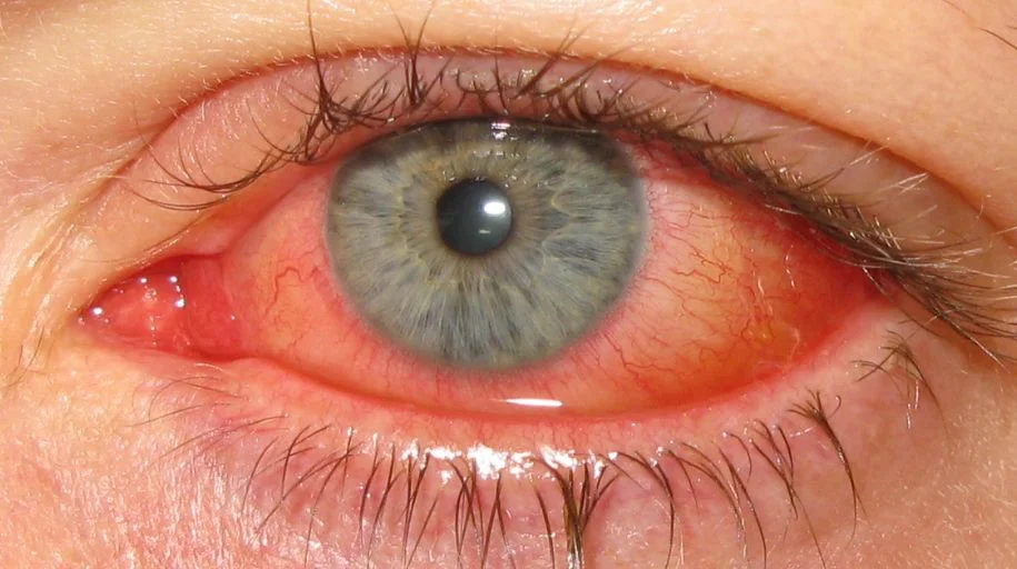 Human Adenovirus Conjunctivitis (Adenoviral Conjunctivitis)