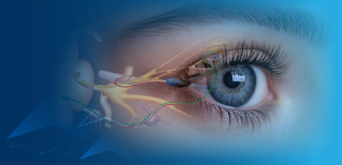Exploring presbyopia progression in patients with glaucoma treated with PF receptor agonists: